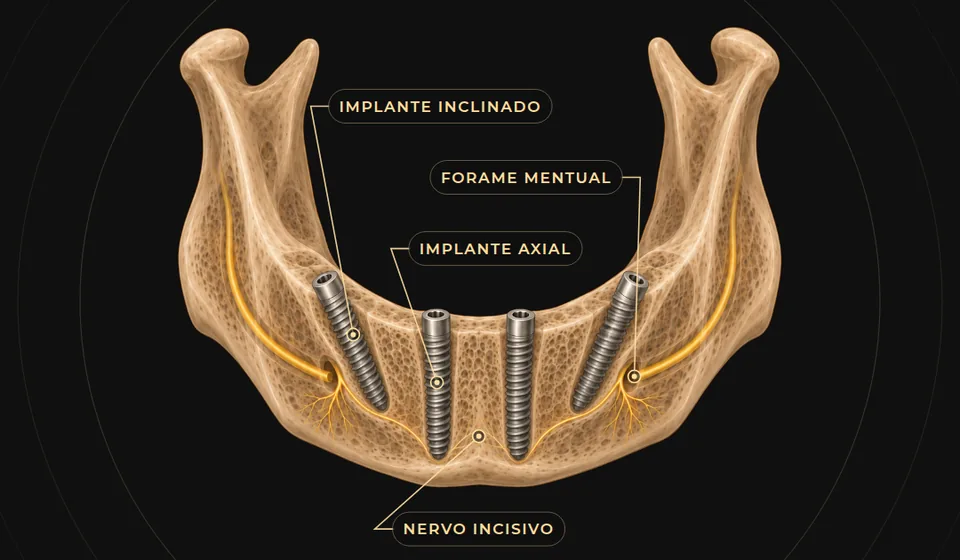 Ilustração de mandíbula com All-on-4: dois implantes axiais anteriores e dois inclinados para distal, à frente do forame mentual